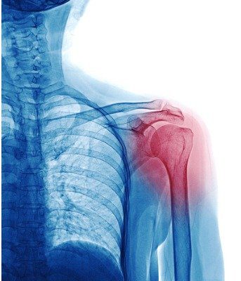 ray-image-of-patient-who-have-shoulder-pain-isolated-on-white-space-picture-id945204528 Fysiotherapie bij frozen shoulder 3